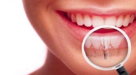 Implantes dentales: precauciones y consejos para que no fracasen