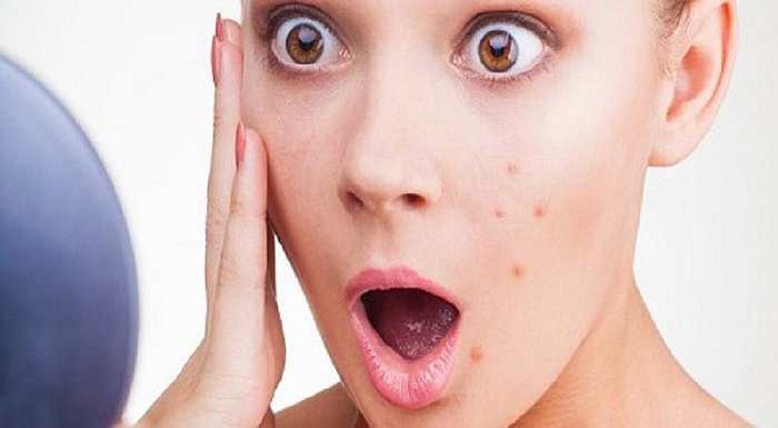 Cómo prevenir el acné