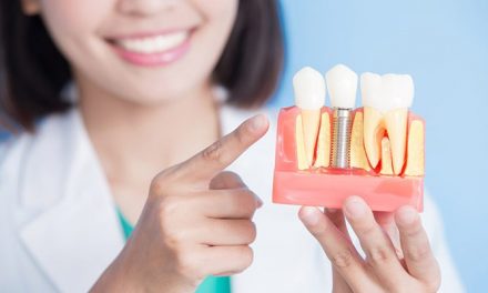 Los implantes dentales ganan cada día más adeptos, descubre porqué