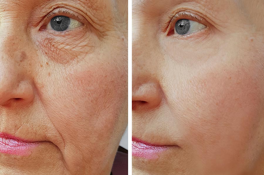 Los más novedosos tratamientos antienvejecimiento para el rostro