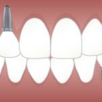 Cómo recuperar tu salud bucodental con implantes dentales