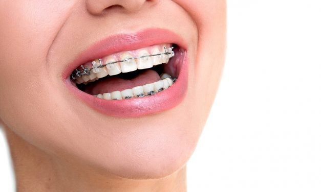 Ventajas de usar el sistema Damon para ortodoncias
